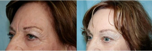 Before and after — Brow Lift