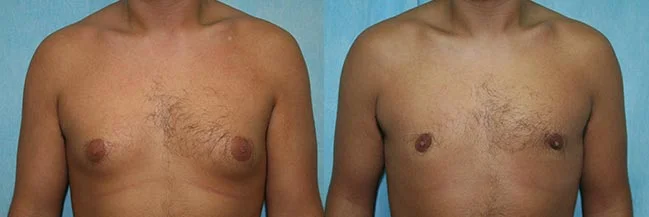 Before and after — Gynecomastia