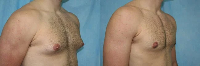 Before and after — Gynecomastia