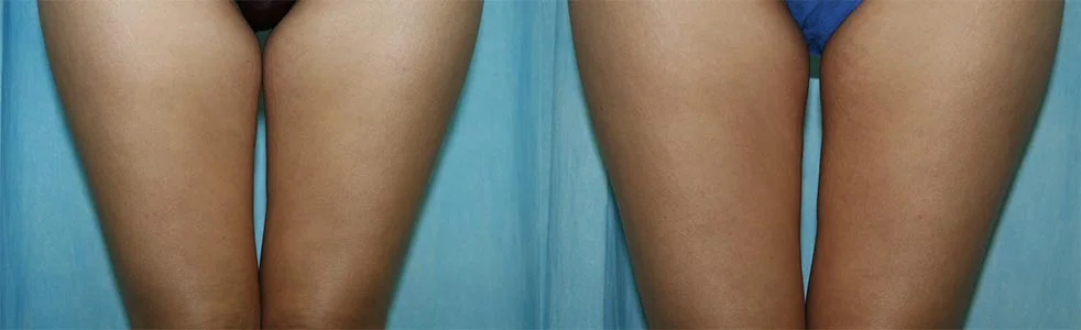 Before and after — CoolSculpting®