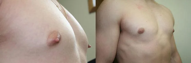 Before and after — Gynecomastia