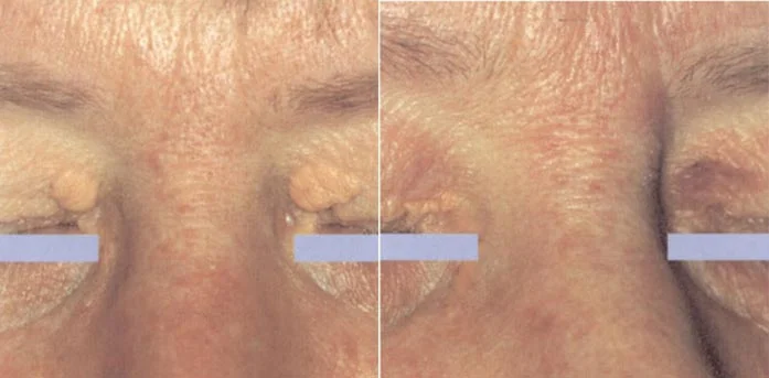 Before and after — Laser Resurfacing