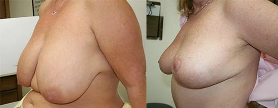 Before and after — Breast Reduction