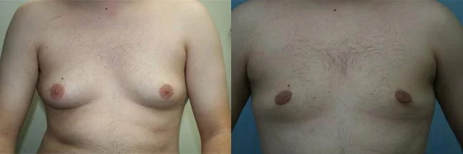 Before and after — Gynecomastia