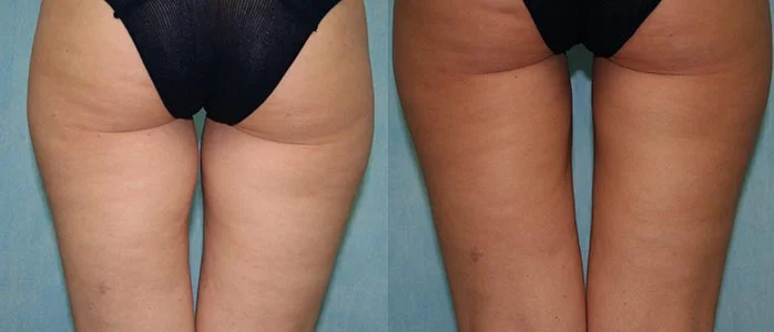 Before and after — CoolSculpting®