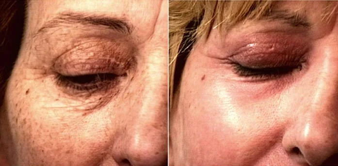 Before and after — Laser Resurfacing