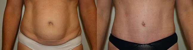 Before and after — Abdominoplasty