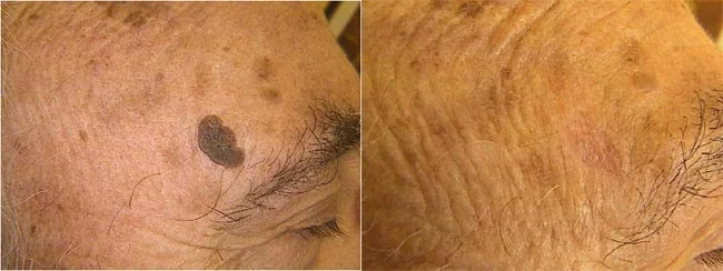 Before and after — Laser Resurfacing
