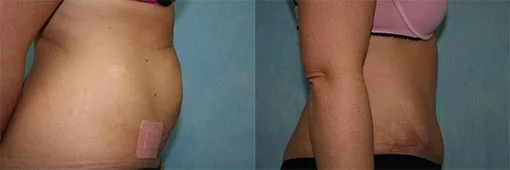 Before and after — Abdominoplasty