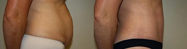 Before and after — Abdominoplasty