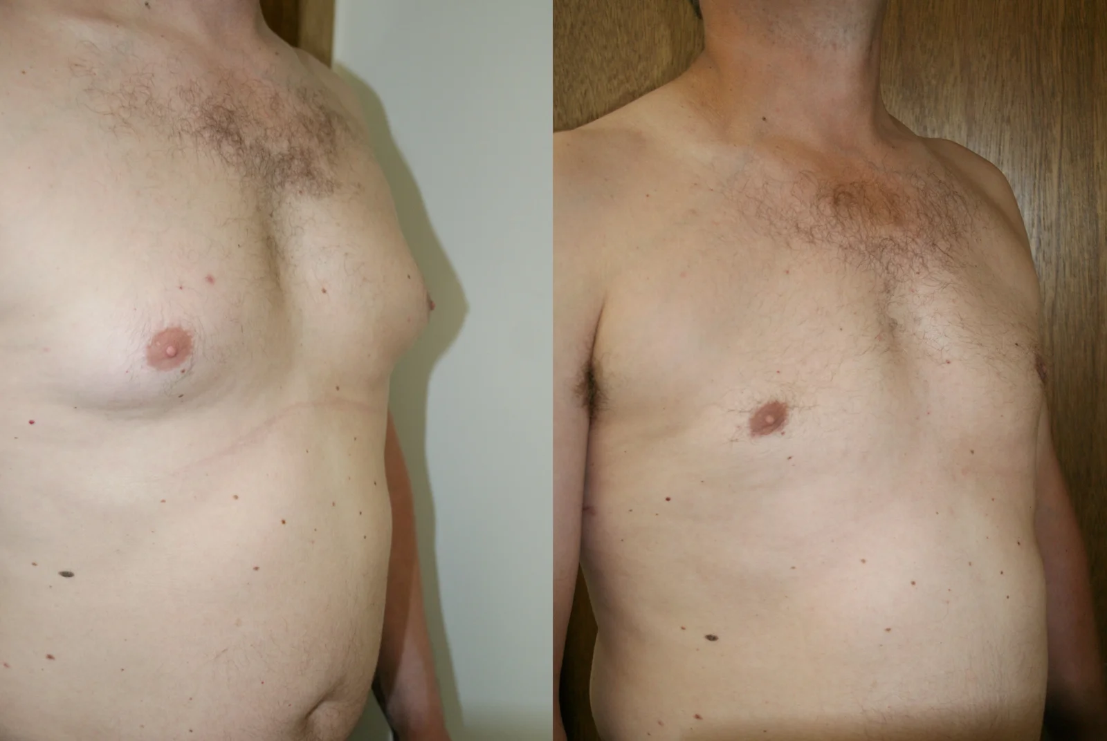 Before and after — Gynecomastia