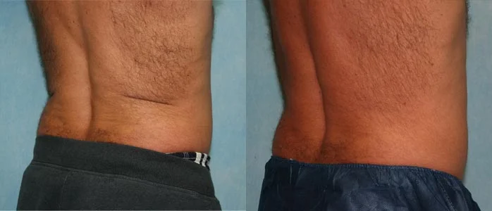 Before and after — CoolSculpting®