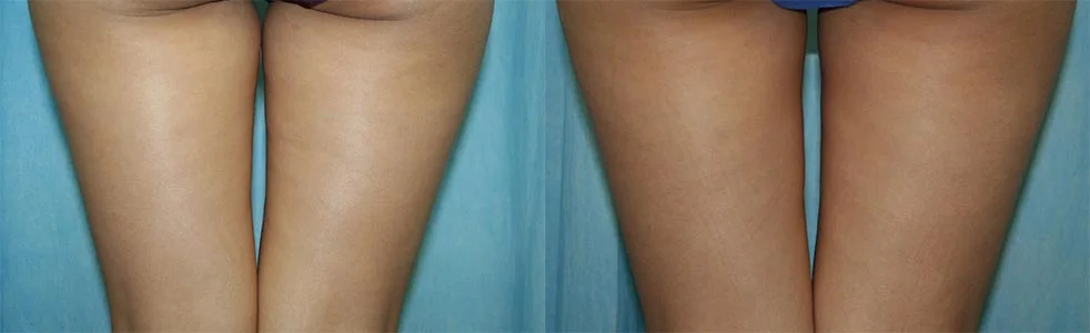 Before and after — CoolSculpting®