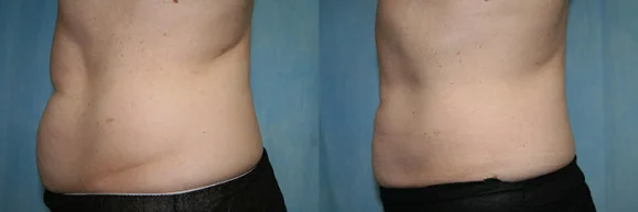 Before and after — CoolSculpting®
