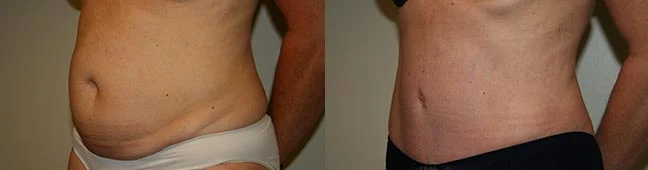 Before and after — Abdominoplasty