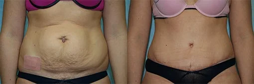 Before and after — Abdominoplasty