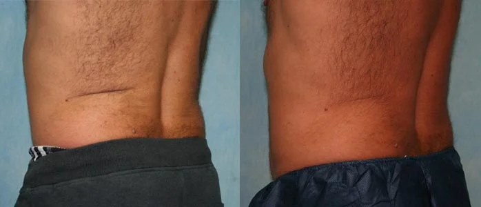 Before and after — CoolSculpting®