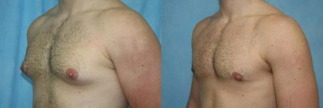 Before and after — Gynecomastia