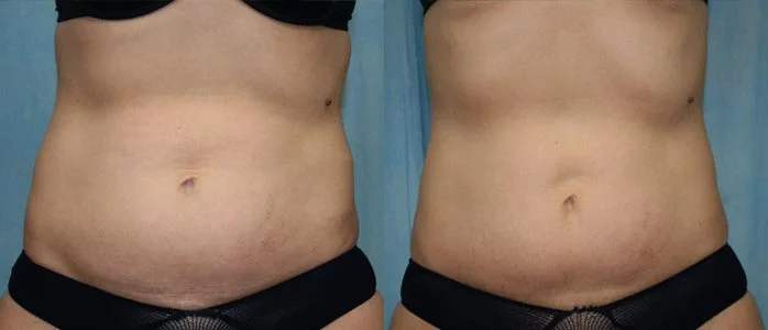 Before and after — CoolSculpting®