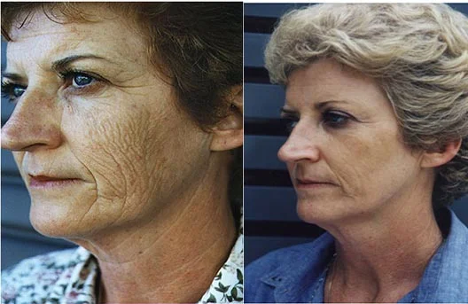 Before and after — Laser Resurfacing