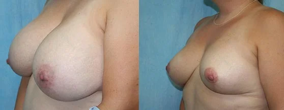 Before and after — Breast Reduction