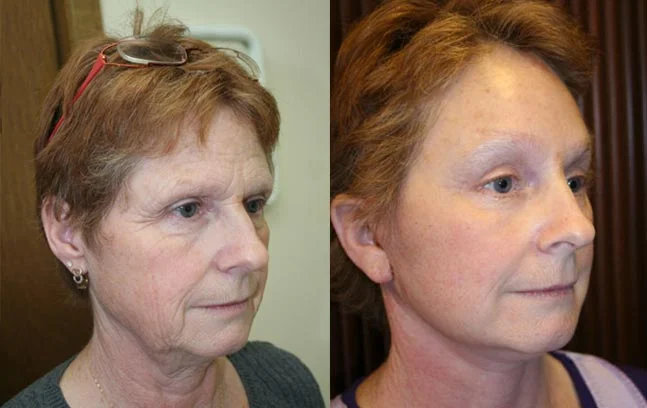 Before and after — Brow Lift