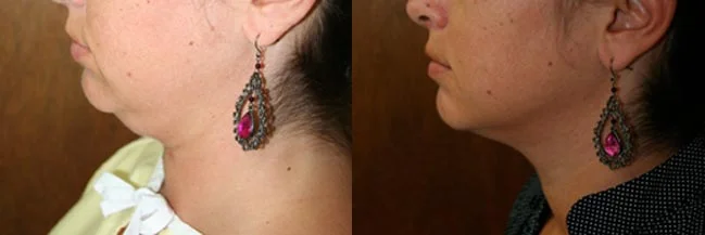 Before and after — Liposuction