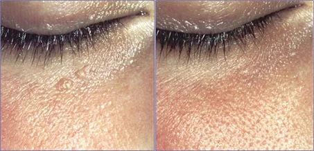 Before and after — Laser Resurfacing