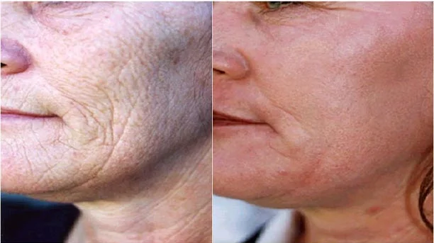 Before and after — Laser Resurfacing