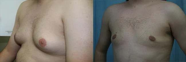 Before and after — Gynecomastia