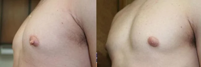 Before and after — Gynecomastia