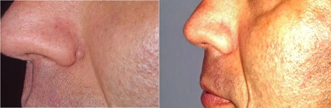 Before and after — Laser Resurfacing