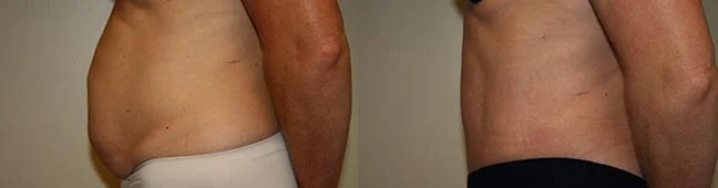 Before and after — Abdominoplasty