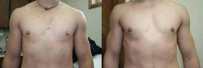 Before and after — Gynecomastia