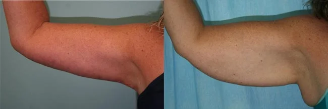 Before and after — Brachioplasty