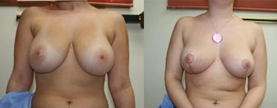 Before and after — Breast Reduction