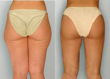 Before and after — Liposuction