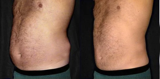 Before and after — Liposuction