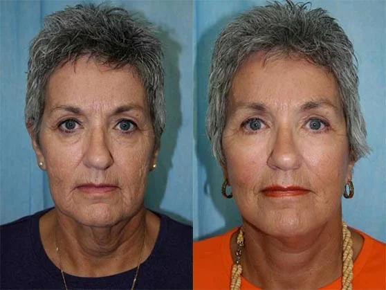 Before and after — Optimum LIFT™
