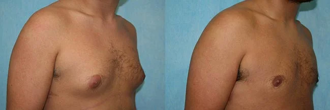 Before and after — Gynecomastia